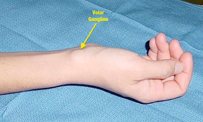 Ganglion Wrist Hand Fingers Hand Surgery Source